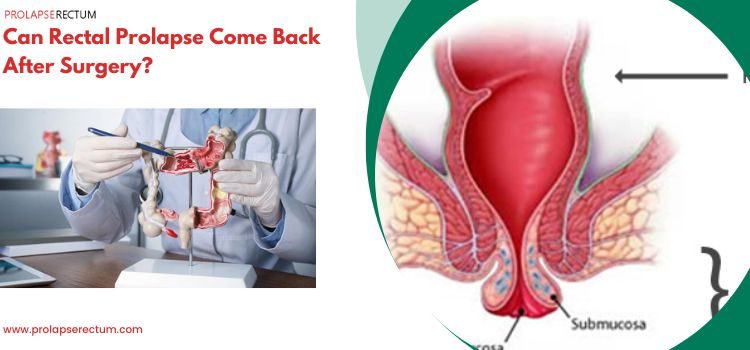 Can Rectal Prolapse Come Back After Surgery? Can Rectal Prolapse Come Back After Surgery?
