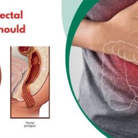 Early Signs of Rectal Prolapse You Should Never Ignore