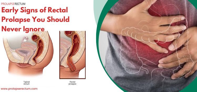 Early Signs of Rectal Prolapse You Should Never Ignore Early Signs of Rectal Prolapse You Should Never Ignore
