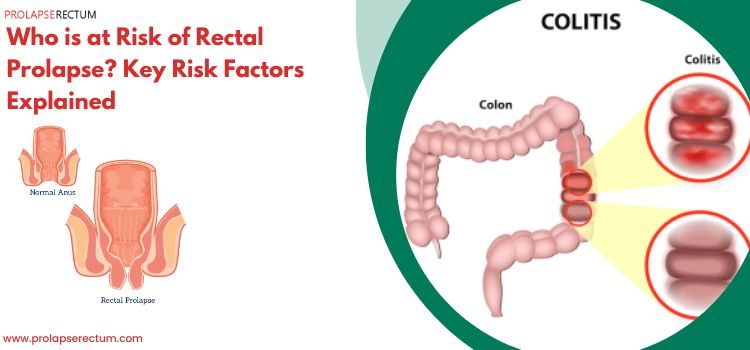 Who is at Risk of Rectal Prolapse? Key Risk Factors Explained Who is at Risk of Rectal Prolapse? Key Risk Factors Explained