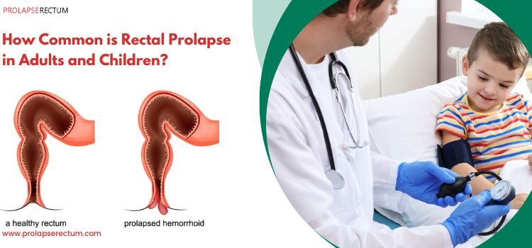How Common is Rectal Prolapse in Adults and Children? How Common is Rectal Prolapse in Adults and Children?
