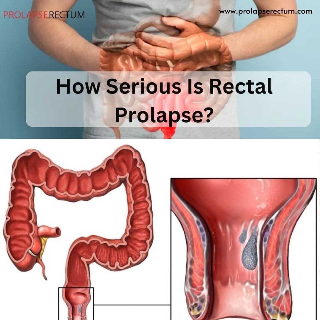 How Serious Is Rectal Prolapse