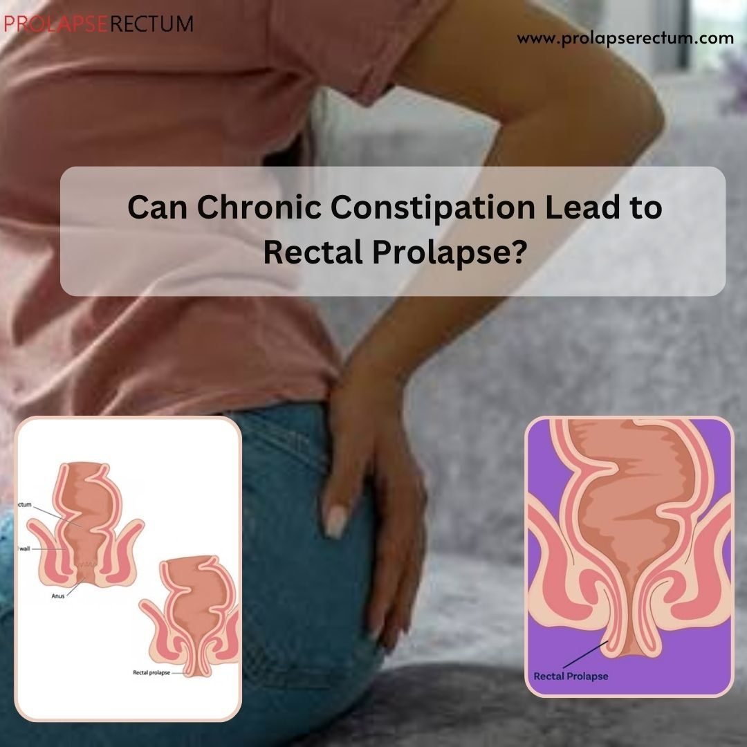 Chronic Constipation and Rectal Prolapse: Causes, Symptoms, and Prevention